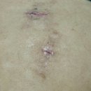 주흥17길 25 (2) | 자궁근종 다빈치 로봇수술 후기4(수술 상처,비용,자궁내막증 관리편)