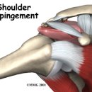 Shoulder Impingement(견관절 충돌증후근) 이미지
