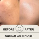 광고없는 리얼 좁쌀여드름과의 전쟁 리뷰3탄 화장품 후기