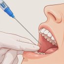 태평가이드치과의원 | 태평역 치과 사랑니 발치 후 회복을 위한 관리 가이드 식사부터 드라이소켓 예방까지