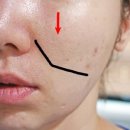 나라온의원 | 마포 대흥역 피부과! 나라온 실리프팅 했어요.