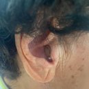 독일렉스톤보청기 이미지