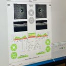 밝은눈안과병원 | 강남 스마일라식 고민하다 밝은눈안과에서 검안 받아본 후기
