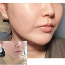 청라브이의원 | 대구 온다리프팅 6만줄 반월당 피부과 2회차 솔직후기