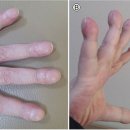 ‘이렇게’ 변한 손가락, ‘암 사망률 1위’ 폐암 징조일 수 있다 이미지