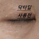 진  전 | 쥐젖제거병원 찾기 전 홈케어부터, 매끈해진 목 피부 관리 후기