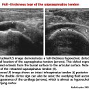 Full-thickness tear of the supraspinatus tendon 이미지