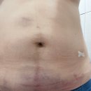 주품디자인 | 무한람스 복부 당일 시술후기 출산 후 다이어트 람스 3번째 찐후기