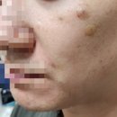 팔자주름 실리프팅 후기 ! 잼버실 전후 가격 비교