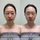 광주피부관리 첨단 에스테티아 이용 후기, 예비신부 윤곽관리 추천