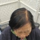 가발대여 맞춤가발 모두 가능한 김호증모가발by헤어리서치