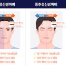 안면마비 원인, 구안와사 전조 및 (벨마비, 안면신경마비) 이미지