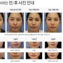 브이라인