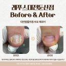 둔산4태권도 | 대전발톱무좀, 태권도 사범님의 실제 관리 성공기!(feat. 3주 주기와 홈케어)