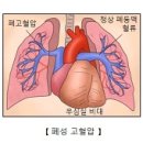 폐동맥 고혈압 이미지