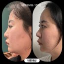 더유스의원 | 여의도 유스의원에서 유스필로 이마볼륨 채우고 5g리프팅으로 팔자주름 삭제한 후기