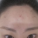 내가할개 | 내돈내산 개빡쳐서 쓰는 명동피부과 울쎄라 300샷 비추후기