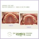 연세라벤더치과교정과치과의원 | 연세라벤더 교정치과 "26년 1월 부분교정 후기"
