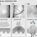 굳은살, 티눈, 사마귀의 차이점 이미지