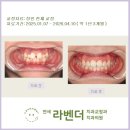 즐거운연세치과 - 안양시 동안구 관악대로 295 | 여의도 교정 연세라벤더치과 "5월 성인 비발치 교정 후기"