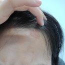 건선 기록! 건선 초기 병원 방문, 조직검사