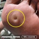 지혜로운네일 | 압구정역 발굳은살 티눈 핵 제거 후기