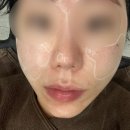 시전 | 내돈내산 모공성흉터 큐어젯+쥬베룩+서브시전+스컬트라 후기 -1