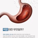 서울삼성요양병원 | 삼성서울병원 암요양병원 반지세포 위암 1기,3기 생존율은