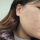 이손약국 | 여드름약 이소티논 처방 1개월 복용 후기