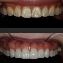 수치과기공소 | 청담수치과 라미네이트 가격 비용 얼마?