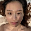 부운빌딩 | 부천피부관리 좁쌀여드름 전문, 더채움에스테틱 4회차 마지막 후기