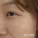 차스킨 - 수원시 권선구 하탑로30번길 27 | [강남스킨보톡스] 잘하는곳 통증없는무통풀페이스 스킨보톡스 3cc 일주일차 솔직후기