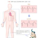 급성 심근경색증(질병분류번호 I21, I22, I23) 이미지