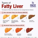 Fatty liver 이미지