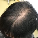 그리닷헤어 | 목포두피관리 남악두피케어 에코레비헤드스파 목포하당점 정수리탈모 여성탈모 에코레비컨셉살롱 개선사례