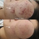 도봉-쌍문-도봉-1154 | 청소년 트러블올라왔을때!? 여드름흉터조심하세요 쌍문늘품에스테틱