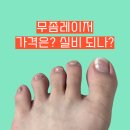발톱무좀 레이저치료 후기 알아보기 (실비, 핀포인트, 루눌라)