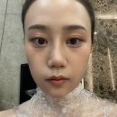 미드림성형외과의원 | 수원 아주대 법원사거리 “미드림성형외과” 편평사마귀 목 리터치 후기