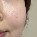 옥수역(3) | 옥수역피부과 쥬베룩스킨, 포텐자 후기 | 통증, 일주일 비교