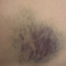 바이러스 | 성인 파보바이러스 감염 한달 후기