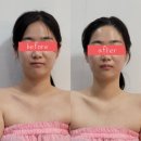 대전윤곽관리 피부이야기 오류점에서 안 아픈 3v윤곽 테라피 받고 온 후기 신부관리로 추천