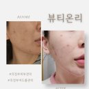 다시온리케어 | 의정부에스테틱 뷰티온리 여드름관리샵 MTS케어 후기