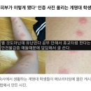 '기숙사에 빈대 출몰' 계명대학교 상황, 현재 이 정도로 심각하다 이미지