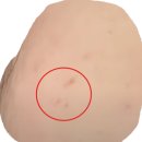 청라바른약국 | 얼굴 편평사마귀 제거 후 관리 찐 후기 비용포함