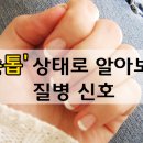 손톱으로 보는 질병신호 이미지