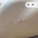 대상포진인지좀 봐주세요 이미지
