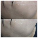 첨단에스테틱 광주플라즈마 전문점에서 미백, 기미관리 받은 후기