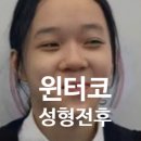 오썸성형외과의원 | 나의 강남 코성형 발품 후기