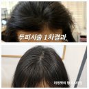 빠질 때 탈모 고생하시는 분들 원주 두피 문신 잘하는 곳 추천 원주 타토아피부과의원 /두피 문신 시술후기