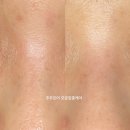 민낯뷰티김천 | [구미 산동 김천 모공케어] 주주모어 원장의 모공수축 집중케어 후기